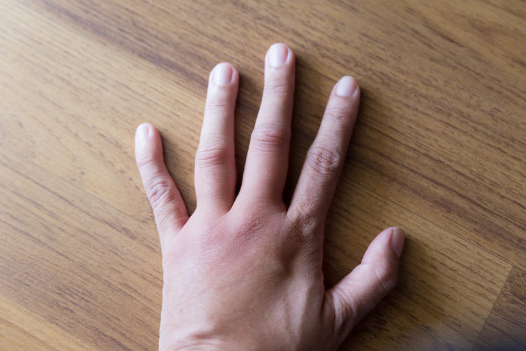 10 Reasons You Have Swollen Fingers Geelong Medical Health Group